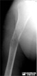 Pathologic Fracture